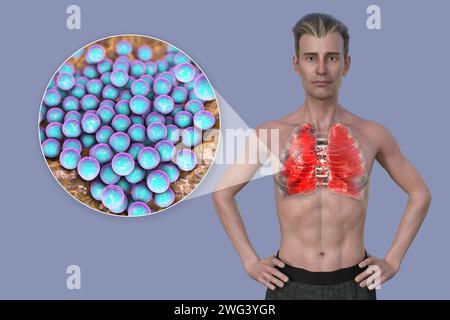 Man with lungs affected by pneumonia, illustration Stock Photo