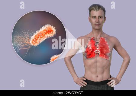 Man with lungs affected by pneumonia, illustration Stock Photo