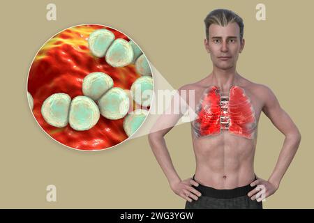 Man with lungs affected by pneumonia, illustration Stock Photo