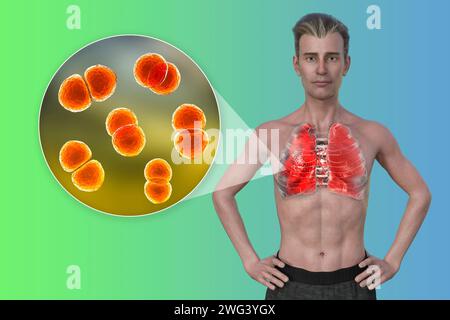 Man with lungs affected by pneumonia, illustration Stock Photo