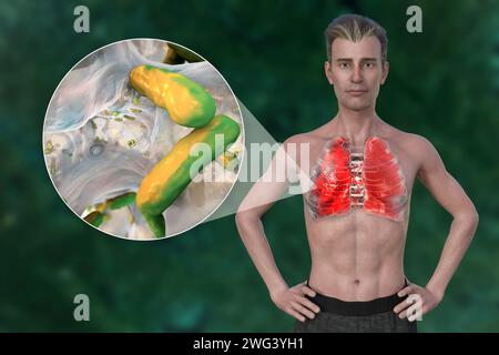 Man with lungs affected by pneumonia, illustration Stock Photo