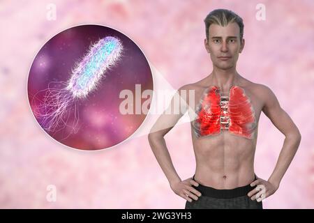 Man with lungs affected by pneumonia, illustration Stock Photo