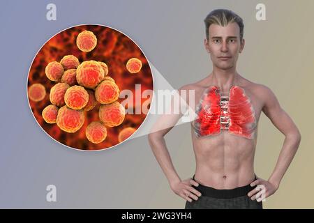 Man with lungs affected by pneumonia, illustration Stock Photo