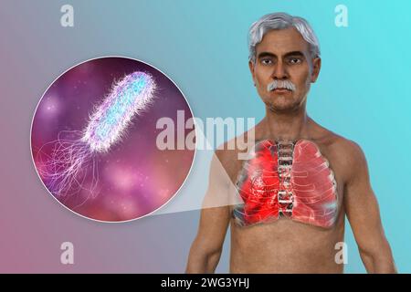 Man with lungs affected by pneumonia, illustration Stock Photo