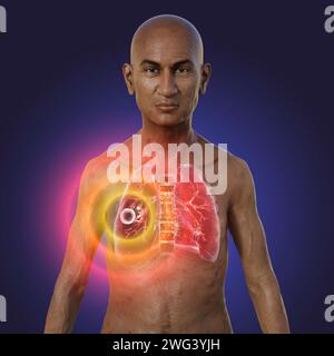 Man with lungs affected by cavernous tuberculosis, illustration Stock Photo
