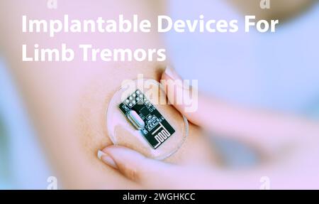 Implantable devices for limb tremors: Devices that provide deep brain stimulation or neuromodulation to reduce tremors in conditions like essential tr Stock Photo