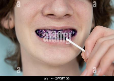 Plaque indicator on human teeth with braces. Plaque is colored pink. Teenager using plaque indicator gel. Teeth care. Stock Photo