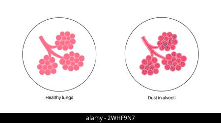 Pneumoconiosis lung disease, illustration Stock Photo