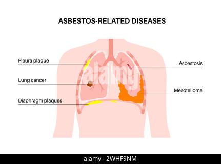 Asbestos related diseases, illustration Stock Photo