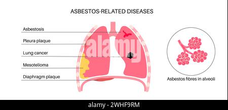 Asbestos related diseases, illustration Stock Photo