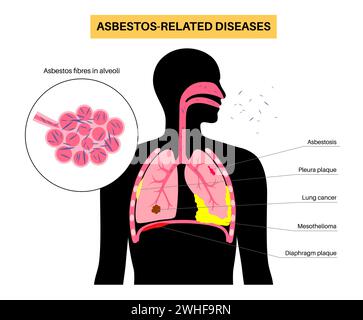 Asbestos related diseases, illustration Stock Photo