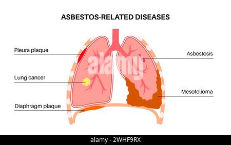 Asbestos related diseases, illustration Stock Photo