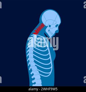 Neck vertebrae deformity, illustration Stock Photo - Alamy