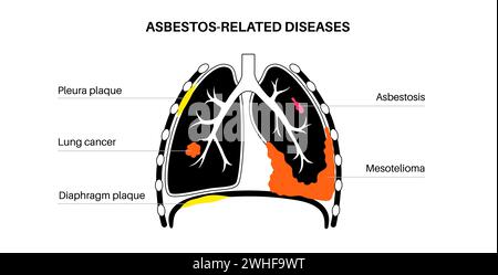 Asbestos related diseases, illustration Stock Photo