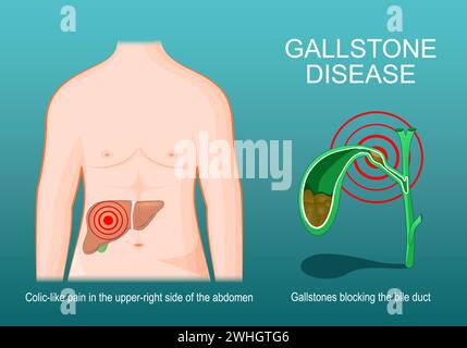 gallstone disease. Human body with liver. Cross section of Gallbladder with Gallstones that blocking of a bile duct. Symptoms of cholelithiasis. Isome Stock Vector