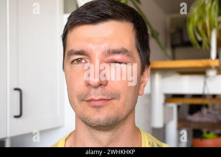 A red swollen eyelid on a man's face in close-up is an allergy to an insect bite. Allergic reaction to blood-sucking insects Stock Photo