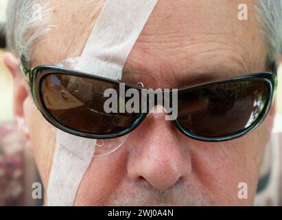 A man is wearing dark sunglasses over a clear eye shield. The shield has been taped over his eye to protect it after cataract surgery. Stock Photo