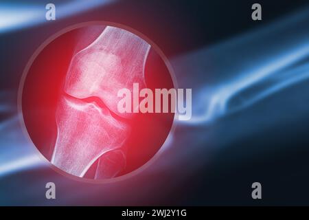 X-ray image of human knee Stock Photo