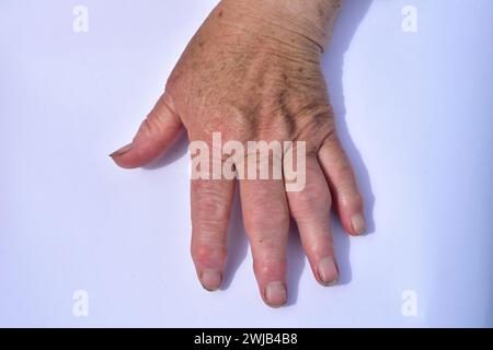 The picture shows the right hand, the fingers of which have signs of arthrosis disease. Stock Photo