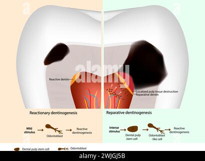Illustration of progress of tooth decay Stock Vector Image & Art - Alamy