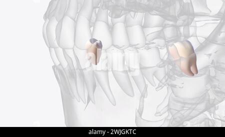 Mandibular third molars usually have two roots: mesial and distal as on ...