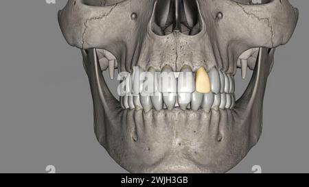 The maxillary lateral incisors are a pair of upper (maxillary) teeth ...