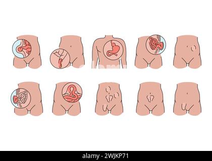 Hernias line icons set. Vector isolated element. Editable stroke. Stock Vector