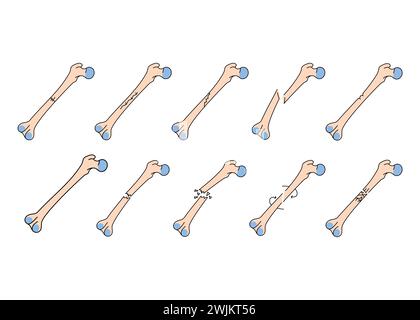 Bone fracture line icons set. Vector isolated element. Editable stroke. Stock Vector