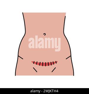 Pfannenstiel incision line icon. Abdominal incisions. Vector isolated ...