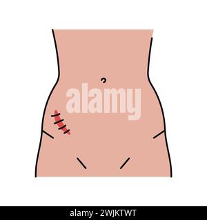 Mcburney incision line icon. Abdominal incisions. Vector isolated ...