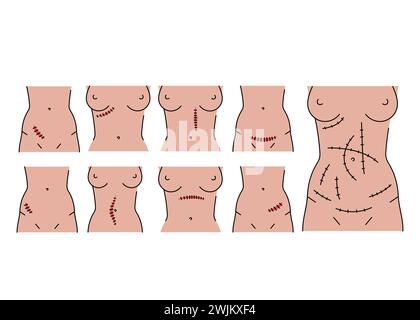 Abdominal incisions line icons set. Vector isolated element. Editable stroke. Stock Vector