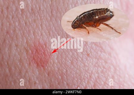 A flea biting on the skin of human hand, drinking blood and causes redness of the skin at the place of the bite. A carrier of disease-causing microorg Stock Photo