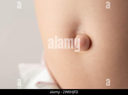 Umbilical hernia of two months old baby. Close up of small umbilical hernia  in baby. Stock Photo
