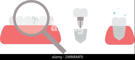 replacement of broken tooth with dental cap Stock Vector