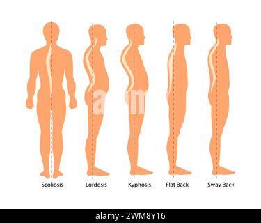 The Position Of The Spine With Lordosis Spinal Curvature Kyphosis Lordosis Scoliosis