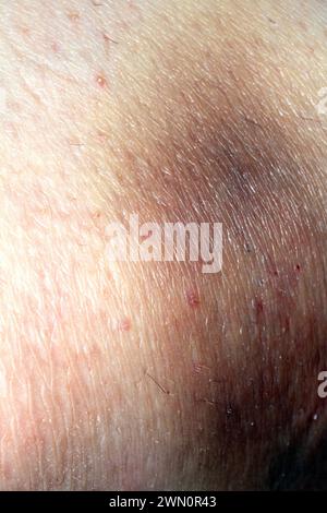 A Close Up of a Big Bruise on a Body Part Knee From Tripping UP and Falling Down Stock Photo