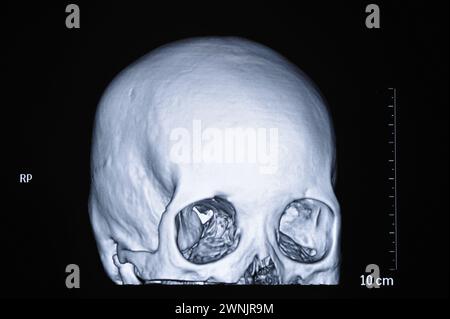 Human skull CT scans Stock Photo