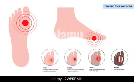 Symptoms of Diabetic Foot Ulcer Stock Photo - Alamy