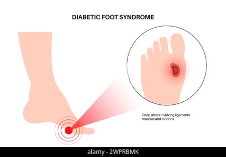 Diabetic foot syndrome, illustration. Deep ulcer, open sore or wound on ...