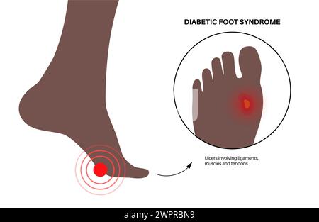 Diabetic foot syndrome, illustration. Deep ulcer, open sore or wound on ...