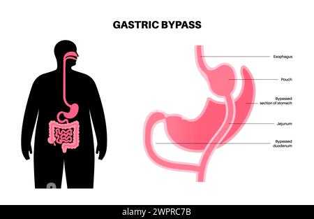 Gastric bypass surgery, illustration Stock Photo