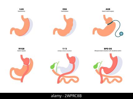 Types of bariatric surgery, illustration. Healthy stomach and internal ...