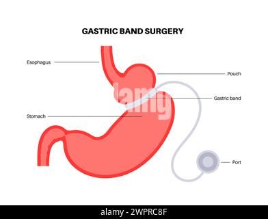 Gastric band medical procedure, illustration Stock Photo