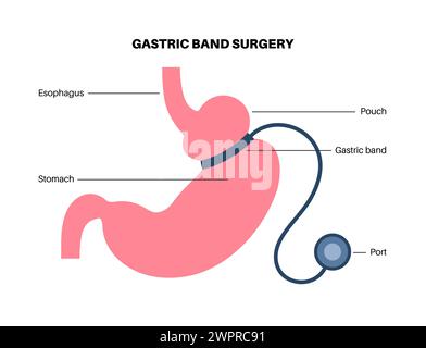 Gastric band medical procedure, illustration Stock Photo