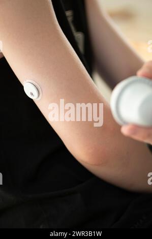 Child holding a setting aid for a glucose sensor, the sensor has been attached to the child's arm, blood glucose measurement, diabetes treatment Stock Photo