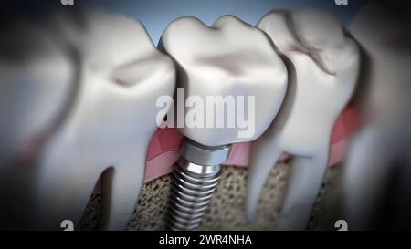 3D rendering of tooth implant showing jaw gum and bone layers. 3D illustration. Stock Photo