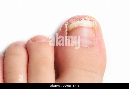 High angle shot of a finger of a child with fungal nail infection against white background. Stock Photo