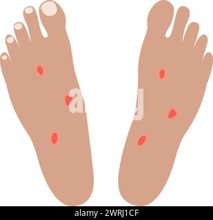 Diabetic foot, ulcer and disease, diabetic foot vector icon, vector graphics Stock Vector