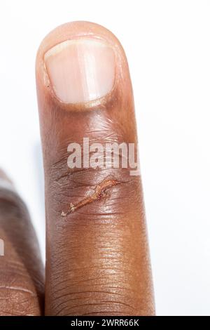 A macro shot showcases the details of a healing scab on a finger, highlighting skin texture and care Stock Photo