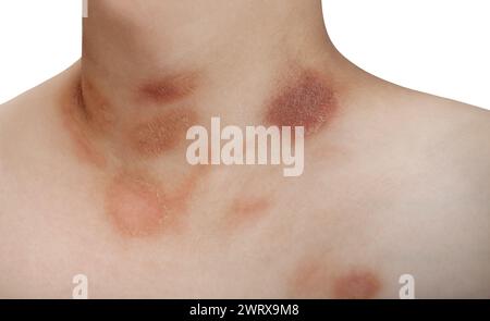 One person with Pityriasis rosea disease on the chest and neck on an isolated background Stock Photo